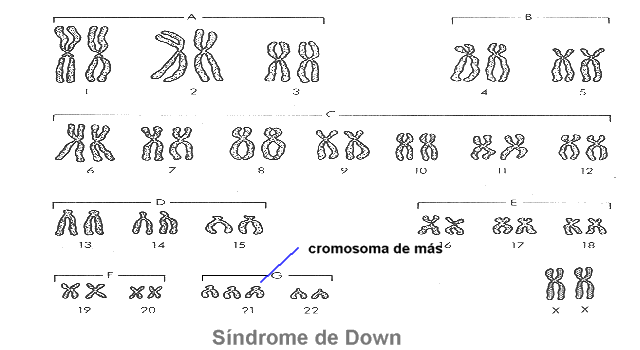 Síndrome Down